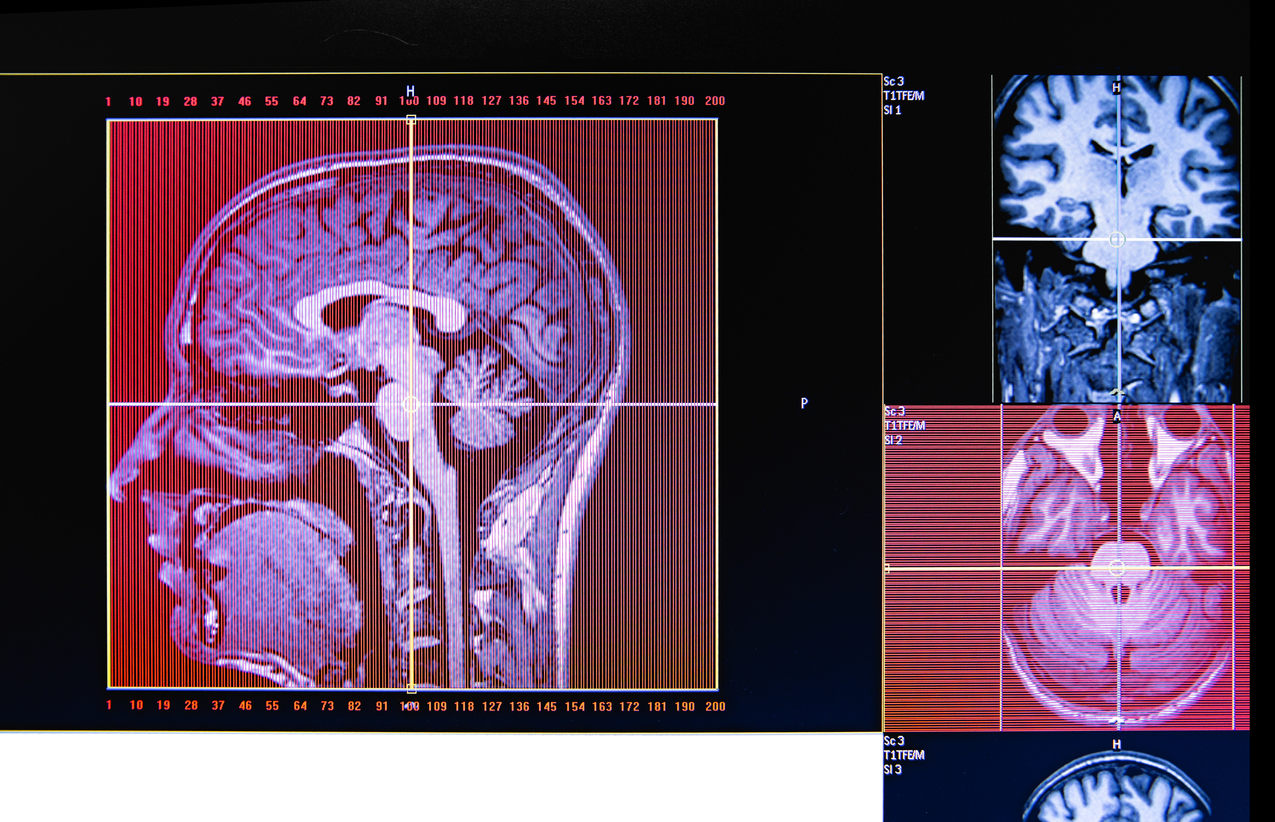 Epilepsi Hakkında Merak Edilenler Prof. Dr. Naz Yeni Epilepsi